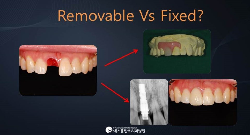 강남 앞니임플란트 — 고정식 임시치아 연결 장면
