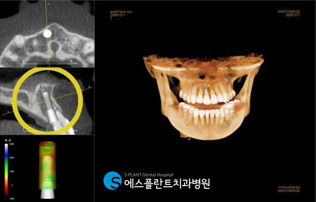 강남 앞니임플란트 정밀검사 — 파노라마·CT 판독 장면