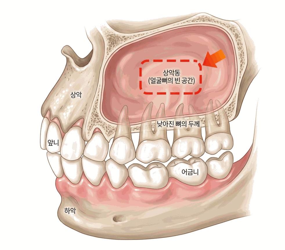 강남 상악동거상술 과정 CT 진단