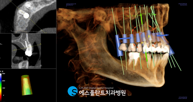 강남 네비게이션 임플란트 CT 3차원 수술 계획 화면